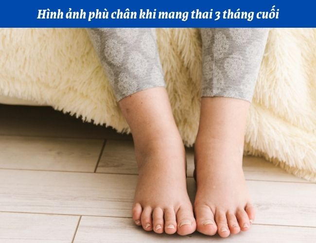 Hình ảnh phù chân khi mang thai 3 tháng cuối của mẹ bầu