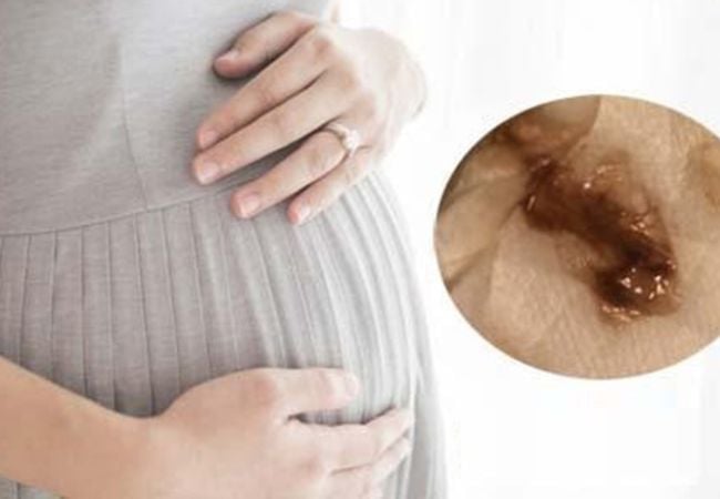 Ra dịch màu nâu có thể là dấu hiệu mang thai giả 
