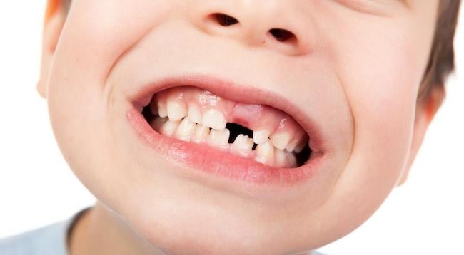 Sâu răng ở trẻ em là gì?