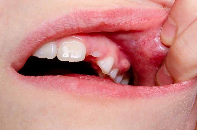  Các giai đoạn của sâu răng ở trẻ em