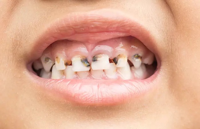 Các dấu hiệu sâu răng ở trẻ em