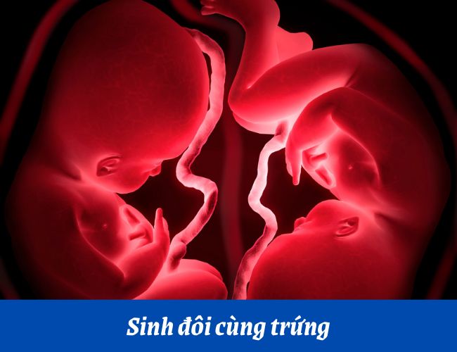 Sinh đôi cùng trứng được hình thành từ cùng một trứng và một tinh trùng