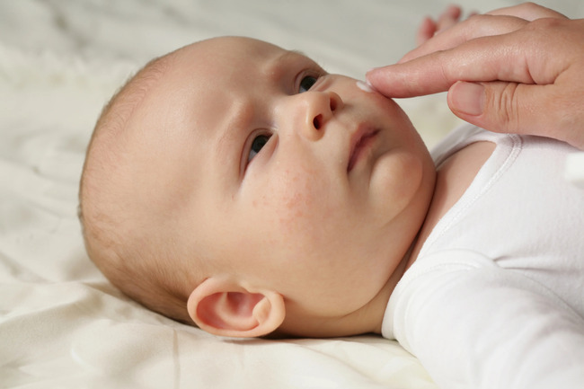 Sốt phát ban ở trẻ các nốt ban rải khắp cơ thể khác với chàm sữa chỉ xuất hiện trên một vùng nhỏ