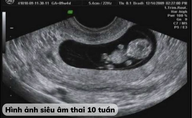 Hình ảnh siêu âm thai 10 tuần