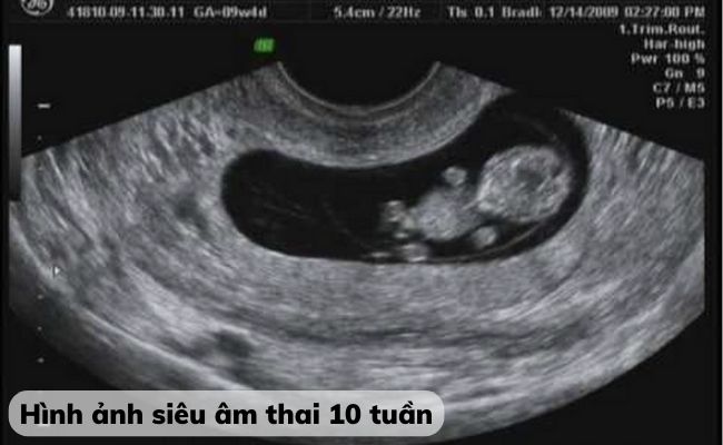 Hình ảnh siêu âm thai 10 tuần tuổi đã biết trai hay gái chưa?