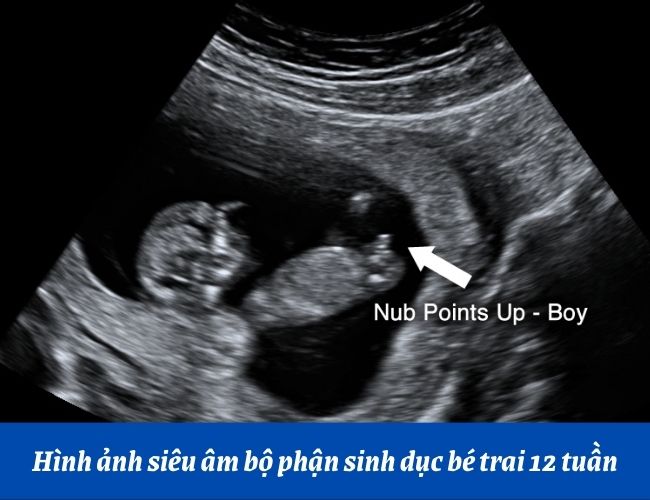 Tham khảo hình ảnh siêu âm bộ phận sinh dục bé trai 12 tuần