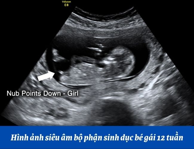 Tham khảo hình ảnh siêu âm bộ phận sinh dục bé gái 12 tuần