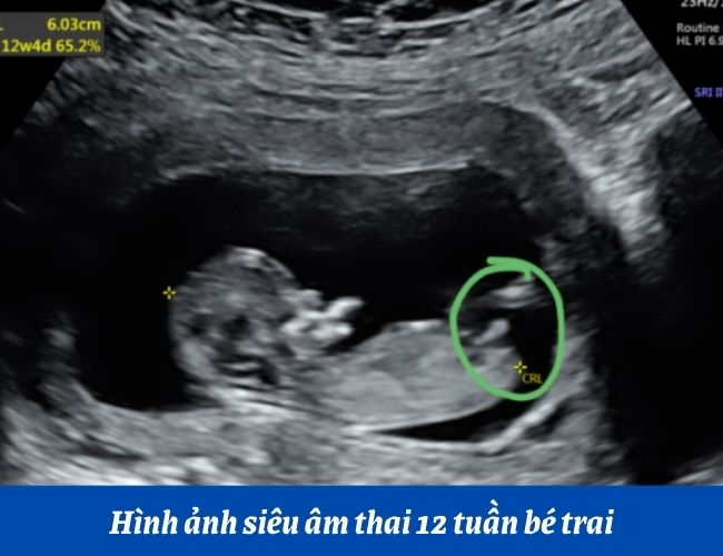 Bộ phận sinh dục bé trai 12 tuần
