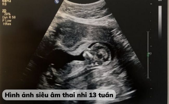Hình ảnh siêu âm thai nhi 13 tuần tuổi
