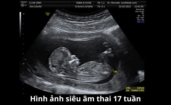 Hình ảnh siêu âm thai 17 tuần