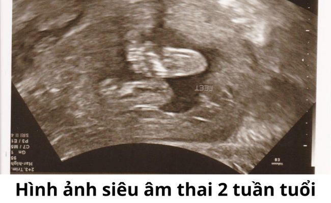 Hình ảnh siêu âm thai 2 tuần tuổi