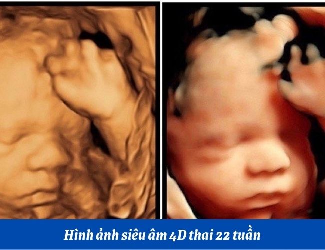 Hình ảnh siêu âm 4D thai 22 tuần