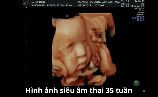 Thai 35 tuần là mấy tháng?
