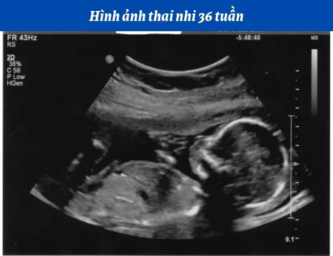 Hình ảnh siêu âm Doppler thai 36 tuần