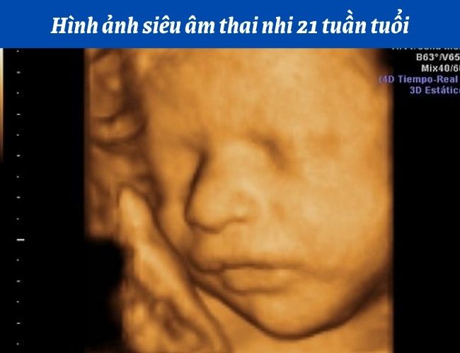 Hình ảnh siêu âm thai nhi 21 tuần tuổi