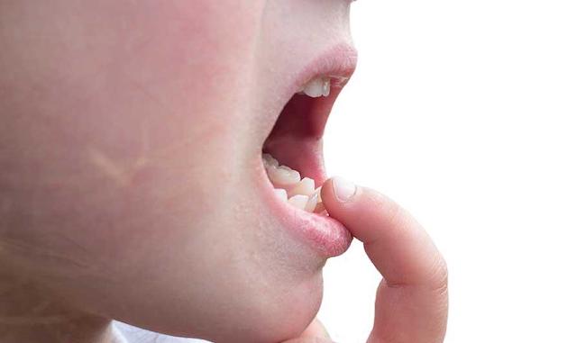 Quá trình sinh lý thay răng sữa của trẻ