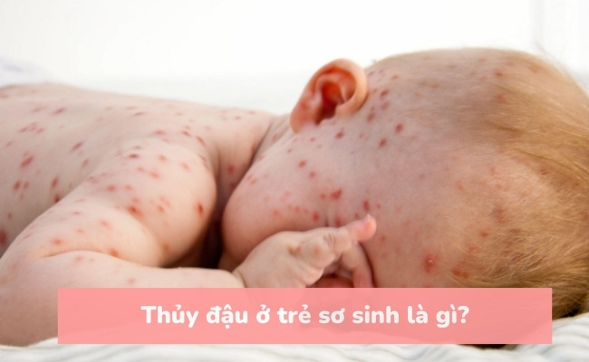 Thủy đậu ở trẻ sơ sinh là gì