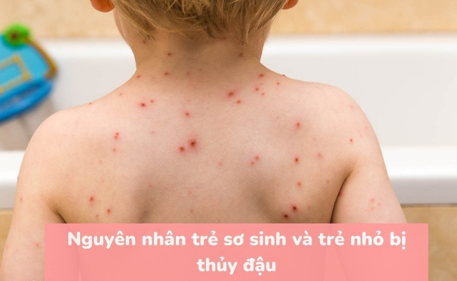 Thủy đậu ở trẻ sơ sinh do nhiễm virus từ bên ngoài