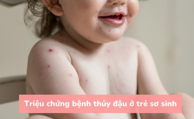 Triệu chứng bệnh thủy đậu ở trẻ sơ sinh