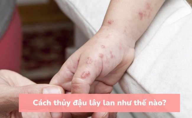 Cách thủy đậu lây lan như thế nào