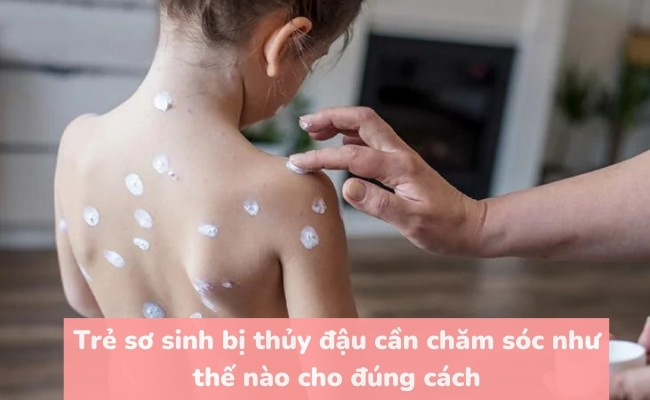 Trẻ sơ sinh bị thủy đậu cần chăm sóc như thế nào cho đúng cách