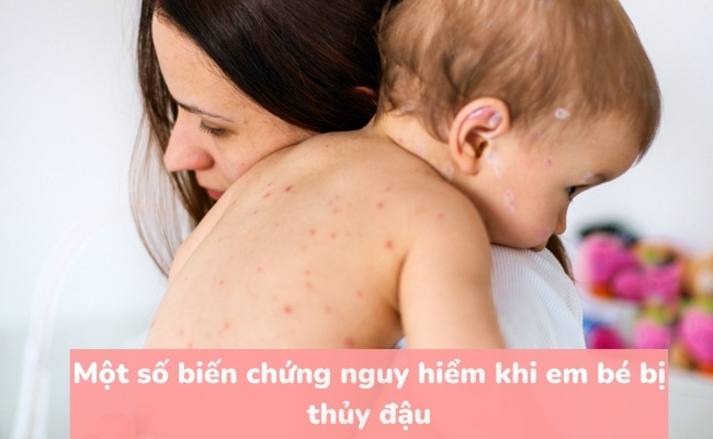 Một số biến chứng nguy hiểm khi em bé bị thủy đậu