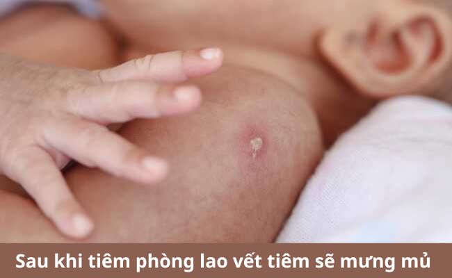 Đau khi tiêm phòng lao vết tiêm sẽ mưng mủ