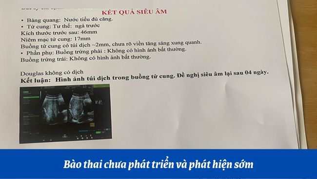Bào bầu chỉ xuất hiện nay rõ rệt qua quýt siêu thanh ở tuần loại 5