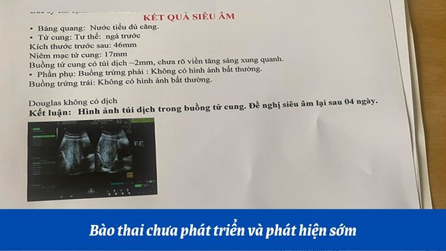 Bào thai chỉ xuất hiện rõ ràng qua siêu âm ở tuần thứ 5