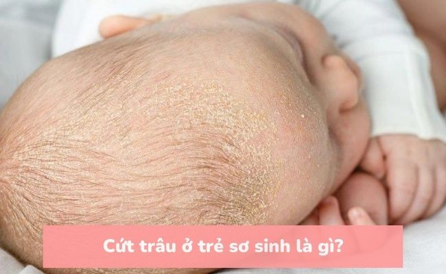 Cứt trâu ở trẻ sơ sinh là gì