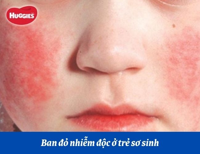 Ban đỏ nhiễm độc ở trẻ sơ sinh