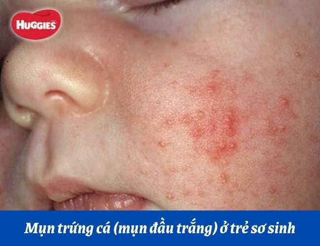 Mụn trứng cá ở trẻ sơ sinh