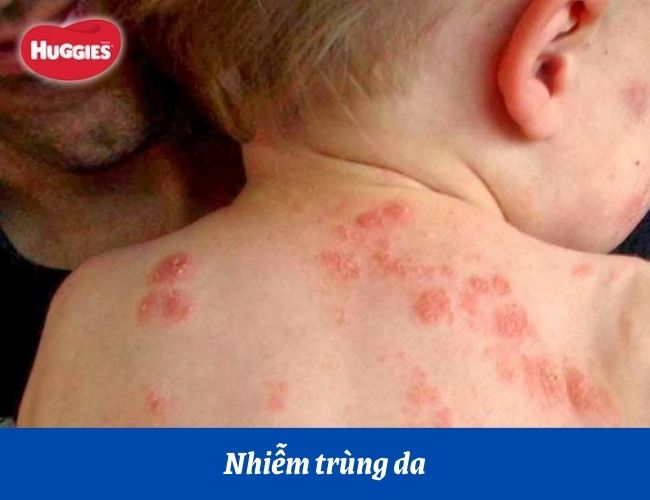 Trẻ sơ sinh bị nhiễm trùng da