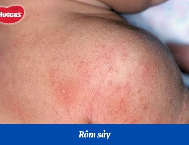 Rôm sảy ở trẻ sơ sinh