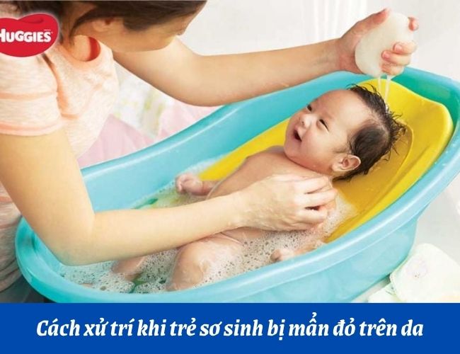 Cách chăm da cho trẻ sơ sinh tránh các bệnh nổi mẩn