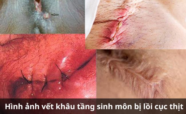 Hình ảnh vết khâu tầng sinh môn bị lồi cục thịt