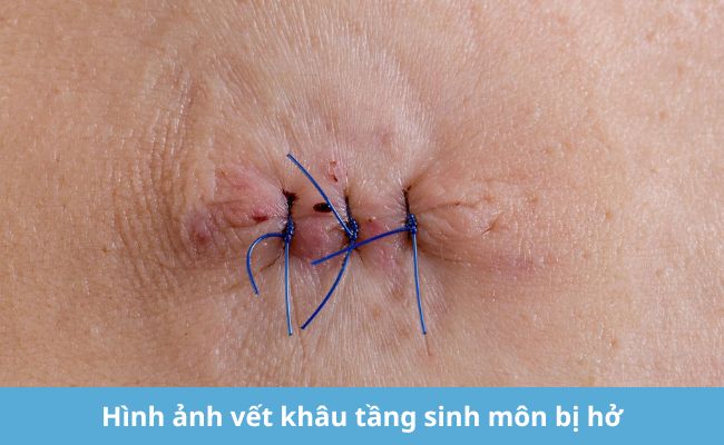 Hình ảnh vết khâu tầng sinh môn bị hở