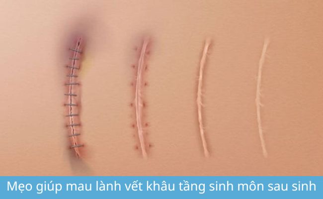 ĐMẹo giúp mau lành vết khâu tầng sinh môn sau sinh