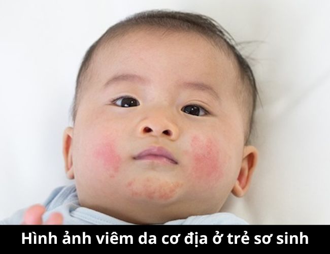 Hình ảnh viêm da cơ địa ở trẻ sơ sinh