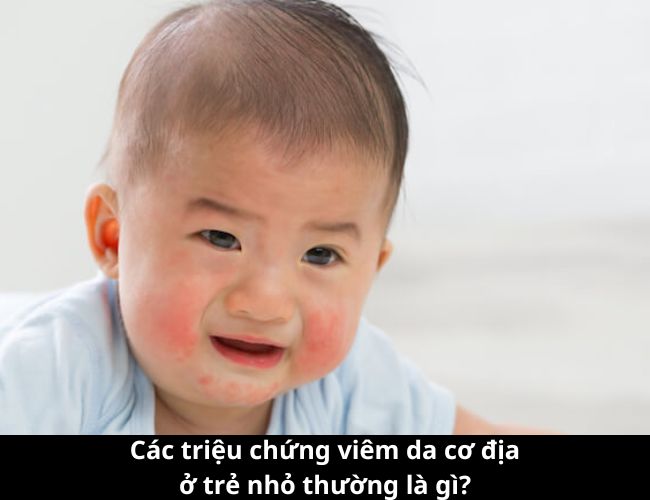Các triệu chứng viêm da cơ địa ở trẻ nhỏ thường gặp là gì?