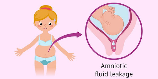 Những lưu ý mẹ cần biết để phòng tránh bị vỡ ối sớm