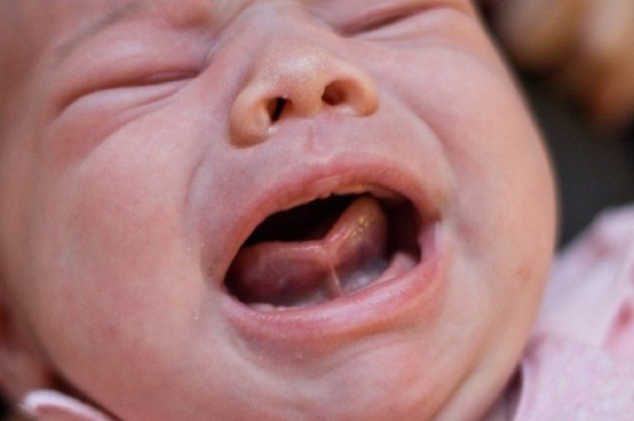 Cách điều trị dính thắng lưỡi ở trẻ sơ sinh