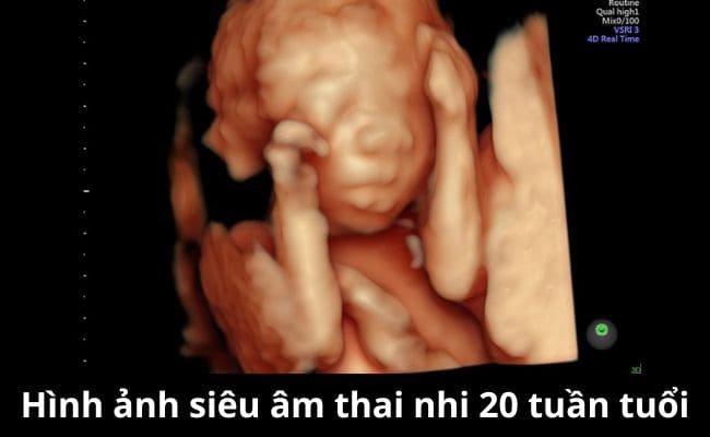 Hình ảnh siêu âm thai nhi 20 tuần (Nguồn: Sưu tầm)