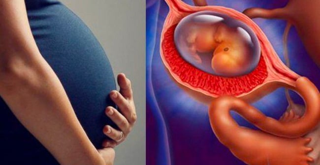 Mang thai ngoài tử cung xảy ra khi trứng làm tổ ở ngoài tử cung gây chảy máu